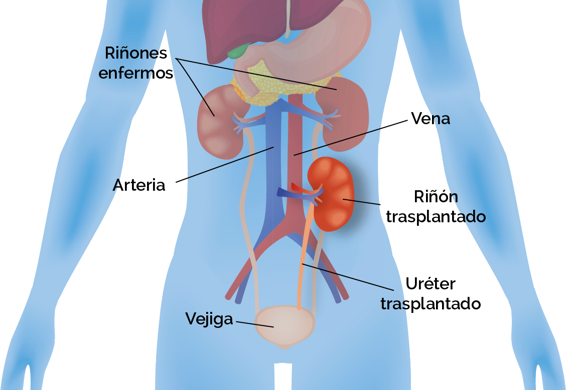 Equilibrio Renal EL TRASPLANTE